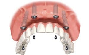 השתלה ביום אחד