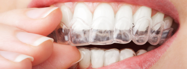 יישור שיניים שקוף