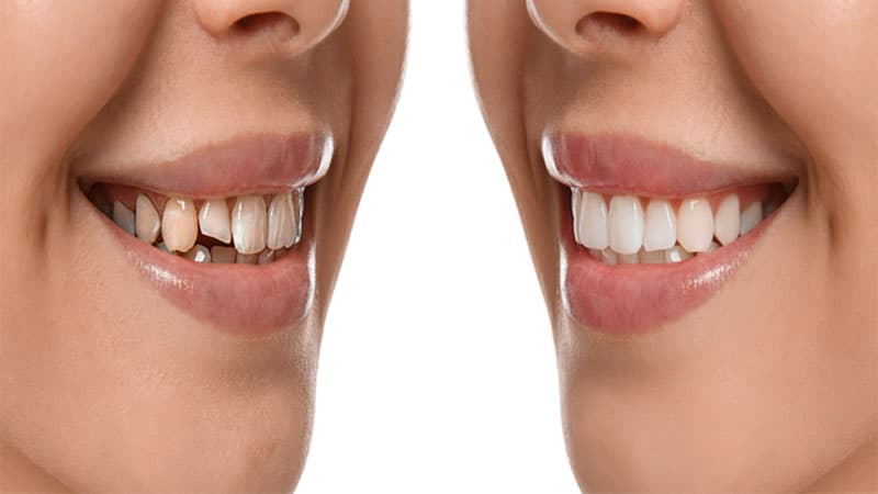 שיקום השיניים בפה תמונה לפני ואחרי