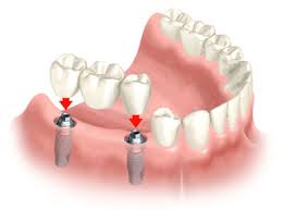 השתלת שיניים יתרונות וחסרונות