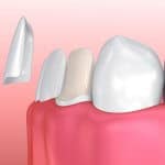 ציפוי שיניים מידע ומחירים