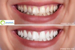 ציפוי קומפוזיט