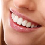 ציפוי קומפוזיט לשיניים