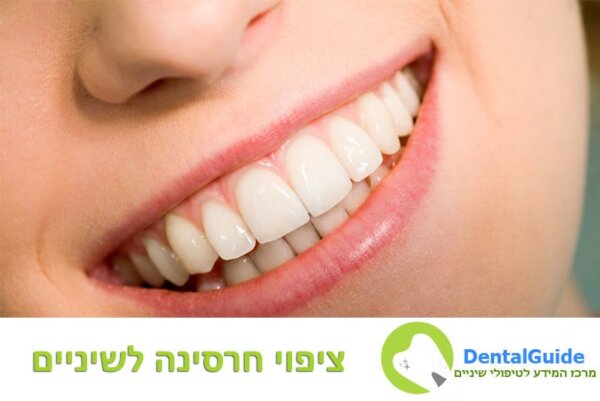 ציפוי חרסינה לשיניים מחירים