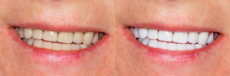ציפוי שיניים לפני ואחרי תמונה