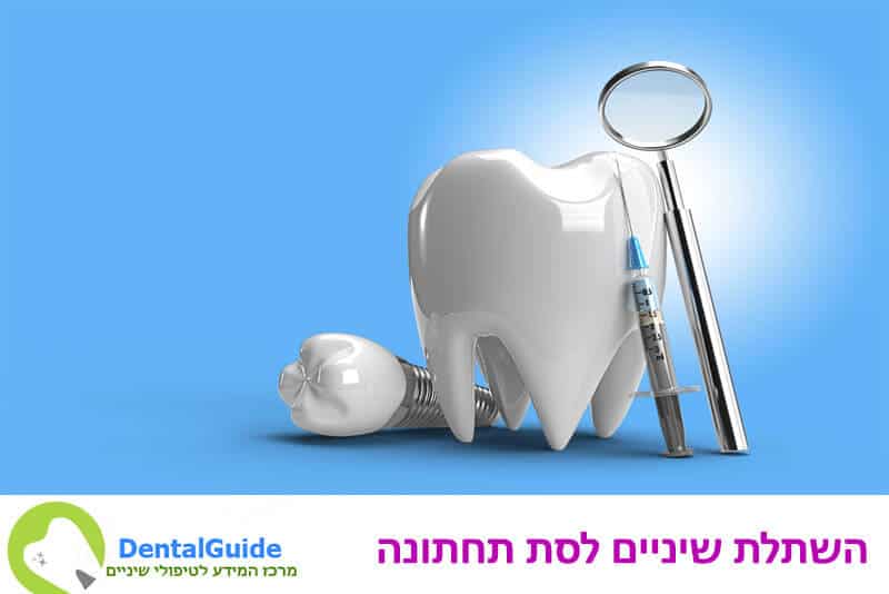 השתלת שיניים לסת תחתונה - מידע, שיטות טיפול (ומחירים)