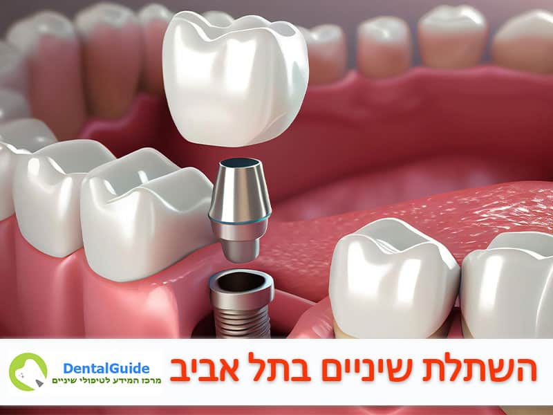 השתלת שיניים בתל אביב