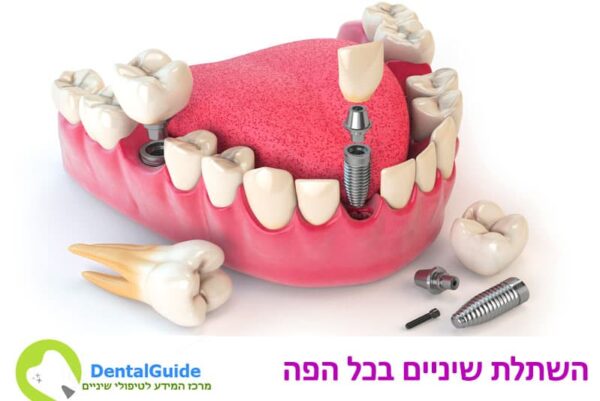 השתלת שיניים בכל הפה