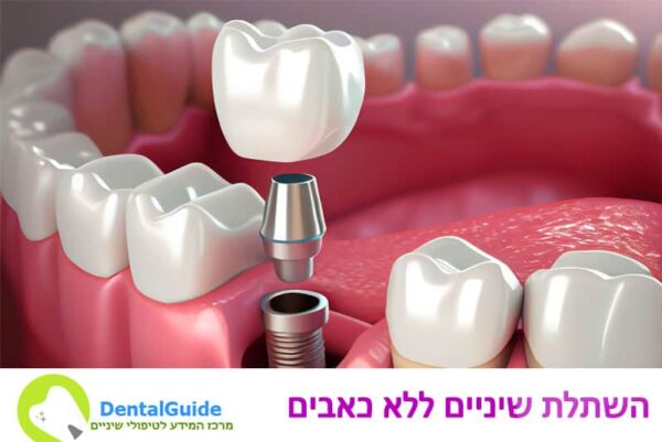 השתלת שיניים ללא כאבים