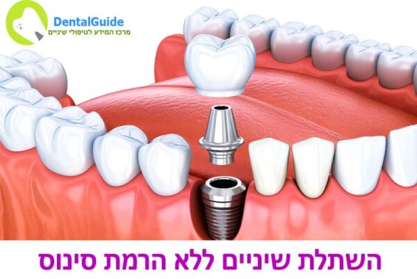 השתלת שיניים ללא הרמת סינוס