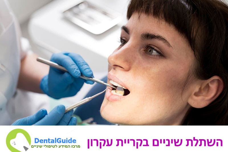 השתלת שיניים בקריית עקרון